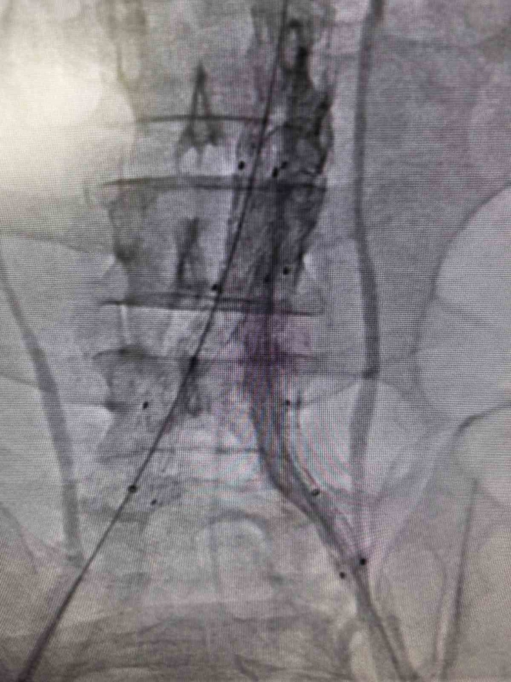 Bilecik’te Hayat Kurtaran Kapalı Damar Operasyonu