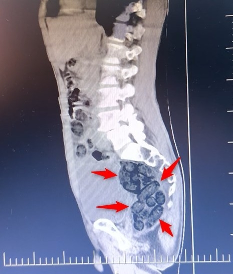 Batman’da Yabancı Uyruklu Bir Şahsın Midesinden 64 Parça Uyuşturucu Çıktı